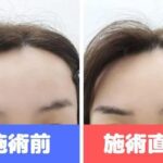 湘南美容外科でアートメイク(眉)を体験した女性のビフォーアフターの写真