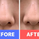 ハイドロジェントル（ハイドロピーリング）を体験した女性の鼻のビフォーアフター